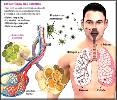 Meningitis tuberculosa esteroides
