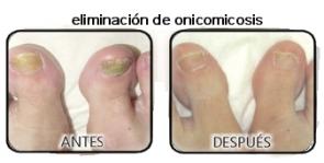 Tratamiento para la Onicomicosis con Fotona Chosse Perfection ahora en Láser Puebla