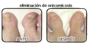 Tratamiento para la Onicomicosis con Fotona Chosse Perfection ahora en Láser Puebla Tratamiento para la Onicomicosis con Fotona Chosse Perfection ahora en Láser Puebla