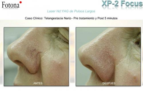Caso Clínico de Telangestacia con Fotona. Dr. Aristides Arellano Caso Clínico de Telangestacia con Fotona. Dr. Aristides Arellano