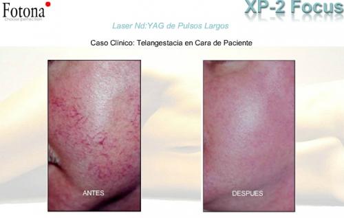 Caso Clínico de Telangestacia con Fotona. Dr. Aristides Arellano Caso Clínico de Telangestacia con Fotona. Dr. Aristides Arellano