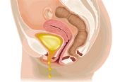Tratamiento para la Incontinencia urinaria y otras alteraciones de la micción. - Uróloga - Dra. Alba Nidia Utrera Acosta