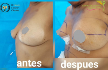 Implante antólogo de grasa a mama - Cirugía estética y Bariatría en Puebla - Dr. Mario Salazar Oliva...