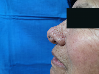 El rinofima es una enfermedad que afecta a la piel de la nariz y se considera como una manifestación...