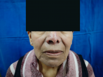 Resultados del tratamiento Crecimiento anómalo de la nariz - Rinofima  - Dr. Alejandro Ortiz Domíngu...