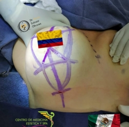 Aumento de senos - Cirugía estética y Bariatría en Puebla - Dr. Mario Salazar Olivares - Puebla