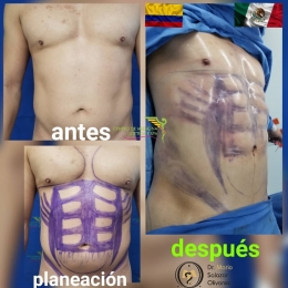 Dr. Mario Salazar en Colombia - Cirugía estética y Bariatría en Puebla - Dr. Mario Salazar Olivares ...