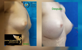 Cirugía estética y Bariatría en Puebla - Dr. Mario Salazar Olivares - Puebla