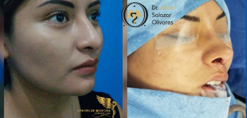 Cirugía estética y Bariatría en Puebla - Dr. Mario Salazar Olivares - Puebla