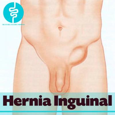 Hernia inghinala - Farmacia Alphega