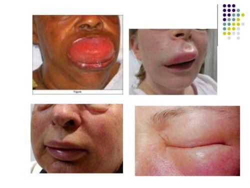 TP - EL ANGIOEDEMA HEREDITARIO (AEH) - Centro de Alergia TP - EL ANGIOEDEMA HEREDITARIO (AEH) - Centro de Alergia