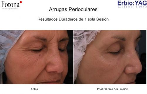 Casos de arrugas con láser de Neodimio:YAG con FOTONA. Dr. Aristides Arellano