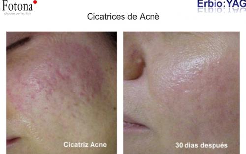 Tratamiento de Acné Activo con FOTONA en Clinica Láser Puebla. Dr. Aristides Arellano