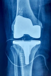 Cirugía Articular - Ortopedista - Dr. Cristian Rivera Reyes