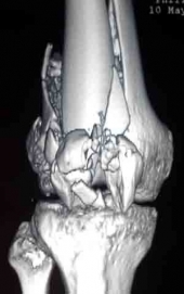 Operaciones de rodilla - Ortopedista - Dr. Jorge Alberto Leyva Medellín