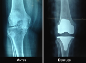 Cirugía para rodillas desgastadas - Ortopedista - Dr. Jorge Alberto Leyva Medellín