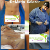  - Cirugía estética y Bariatría en Puebla - Dr. Mario Salazar Olivares