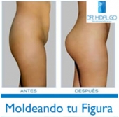 Utilizamos técnicas profesionales para moldear el cuerpo sin cirugía - Dermatólogo - Dr. Luis René Hidalgo Galván