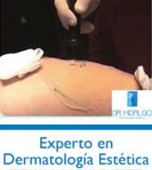 Microdermoabrasión para estrías - Dermatólogo - Dr. Luis René Hidalgo Galván