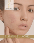 El acné es una alteración de la piel, el cual se puede ir disminuyendo hasta lograr su eliminación. - EPIDERNOVA Cuidados Médicos y Estéticos