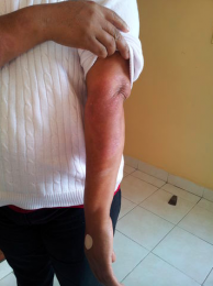 psoriasis  en la 4ta sesión del tratamiento en brazos - Bariatra en Puebla - Dr. Alejandro Domínguez...