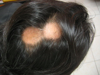 Alopecia antes del tratamiento - Bariatra en Puebla - Dr. Alejandro Domínguez Díaz - Medicina Biológ...