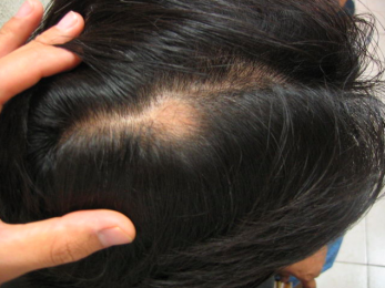 Alopecia despúes del tratamiento y en recuperación - Bariatra en Puebla - Dr. Alejandro Domínguez Dí...
