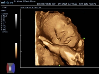 Tp Fotos De Conoce Hoy A Tu Bebe Con El Ultrasonido 3d Ginecologia Y Obstetricia Dr Marco Antonio Macip Meza Puebla Todopuebla Com