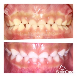 Tratamiento para corregir la mordida SmileCare   - SmileCare Clínica Dental de Especialidades - Pueb...