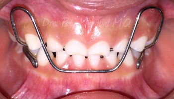 Como saber si muerdo bien, diagnostico con SmileCare - SmileCare Clínica Dental de Especialidades - ...