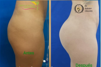 Implante de cuarzo de gel siliconen glúteo - Cirugía estética y Bariatría en Puebla - Dr. Mario Sala...