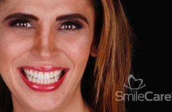 Resultado final - Diseño de sonrisa - SmileCare Clínica Dental de Especialidades - Puebla