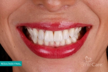 Fase 2 Restauración final - Diseño Digital de Sonrisa
2 Restauración final. 
Especialista: Estétic...