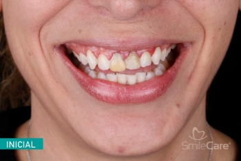 Ella  cambio su sonrisa amarilla y sangrado de encía que tanto le molestaban de años SmileCare  - Ci...