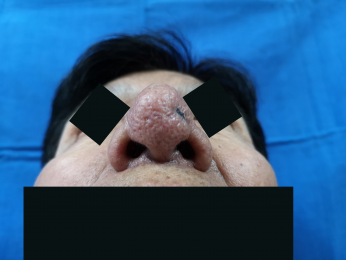 Antes del tratamiento -Crecimiento anómalo de la nariz Rinofima  - Dr. Alejandro Ortiz Domínguez - O...