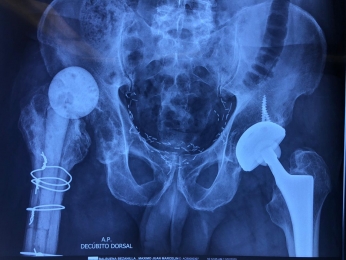 Cambio de prótesis por aflojamiento con Metal Ultraporoso - Ortopedista - Dr. Cristian Rivera Reyes ...