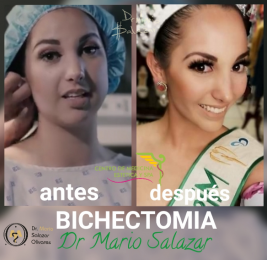 Cirugía estética y Bariatría en Puebla - Dr. Mario Salazar Olivares - Puebla