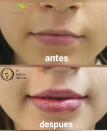 Cirugía estética y Bariatría en Puebla - Dr. Mario Salazar Olivares - Puebla