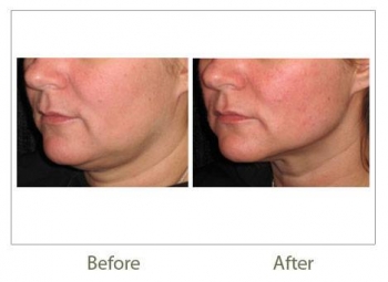 Tratamiento para todo tipo de piel. - Beleco - Medicina Estética - Puebla