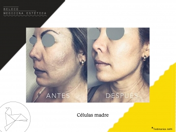 Beleco - Medicina Estética - Puebla