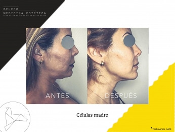 Beleco - Medicina Estética - Puebla