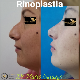 Cirugía estética y Bariatría en Puebla - Dr. Mario Salazar Olivares - Puebla