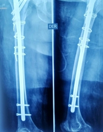 Fracturas de cadera complejas - Ortopedista - Dr. Cristian Rivera Reyes - Puebla