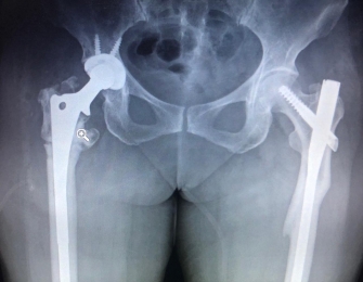 Fracturas de cadera con fallo del manejo incial - Ortopedista - Dr. Cristian Rivera Reyes - Puebla