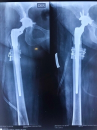 Secuelas de displasia de cadera severa - Ortopedista - Dr. Cristian Rivera Reyes - Puebla
