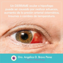 Dra. Angélica D. Bravo Pérez - Cirujana Oftalmóloga - Puebla
