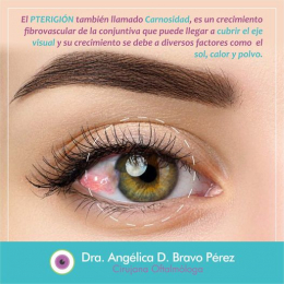 Dra. Angélica D. Bravo Pérez - Cirujana Oftalmóloga - Puebla