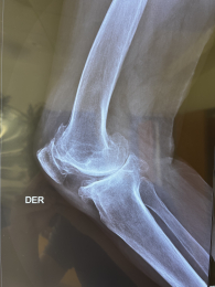 Rx lateral de rodilla derecha con pérdida del espacio articular, con pérdida de la anatomía - Ortope...
