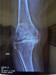Rx ap de rodilla derecha con artrosis, perdida de la anatomía, del espacio articular - Ortopedista -...