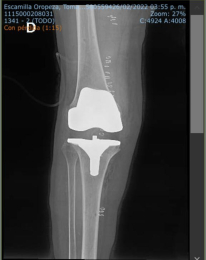 Rx ap de rodilla derecha con muy buena alineación, con adecuado espacio articular - Ortopedista - Dr...